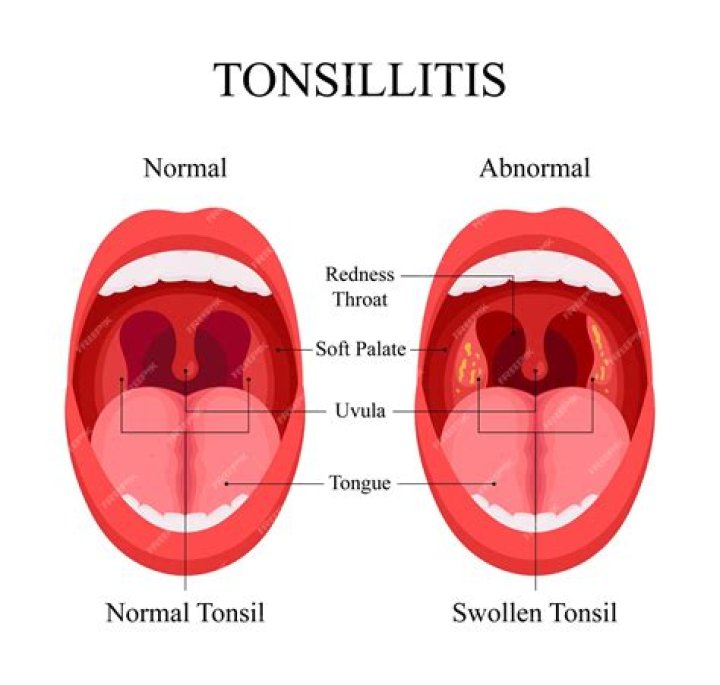 Why does tonsillitis happen?