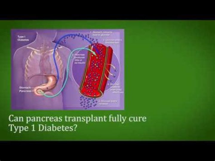 Will a pancreas transplant cure diabetes?