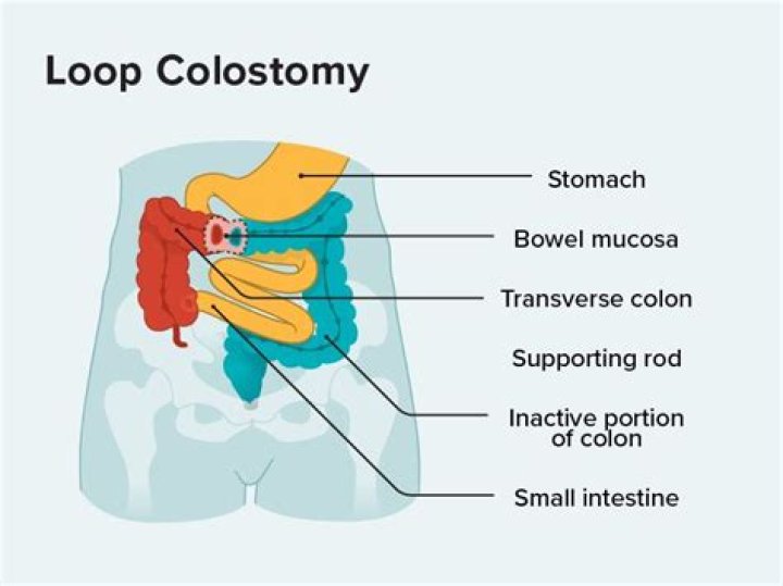 Will i be loopy after colonoscopy?