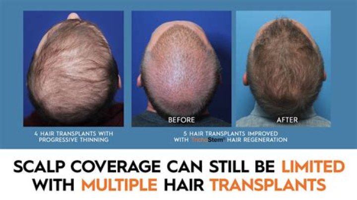 Will i need multiple hair transplants?