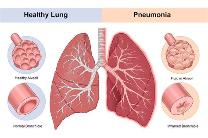 Will pneumonia cause low oxygen levels?
