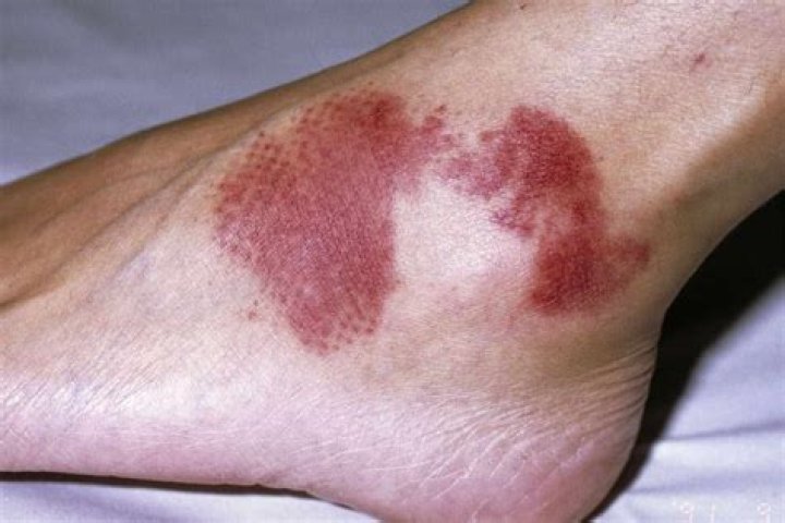 Will purpura go away?